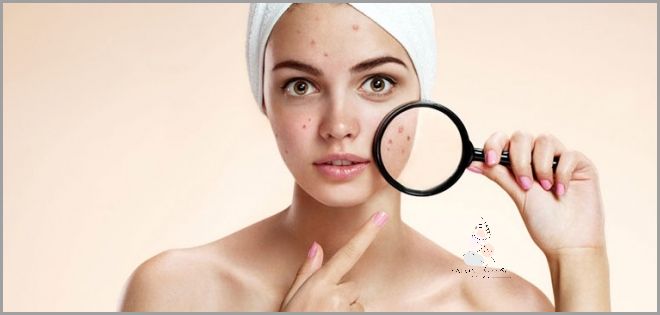 Jak Skutecznie Dbać O Cerę Trądzikową?