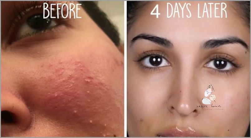 Jak Skutecznie Pozbyć Się Krost Z Twarzy?