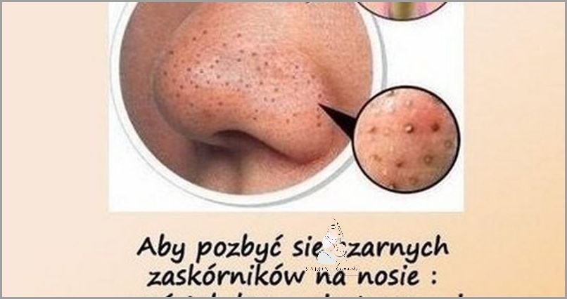 Jak Skutecznie Pozbyć Się Zaskórników Z Nosa?