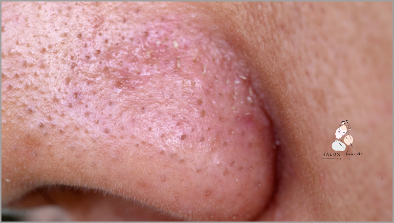 Jak Skutecznie Pozbyć Się Zaskórników Z Nosa?