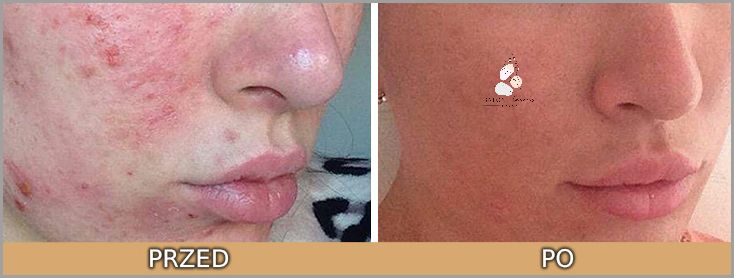 Karmienie Piersią i Kwas Salicylowy: Co Ty na To?