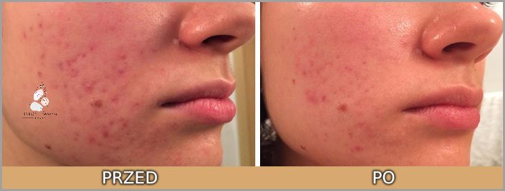 Karmienie Piersią i Kwas Salicylowy: Co Ty na To?