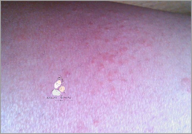 Koniecznie Przeczytaj: Fotodermatoza Uczulenie Na Słońce