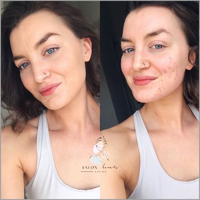 Kuracja Kwasem - Skuteczny Sposób na Trądzik Różowaty!