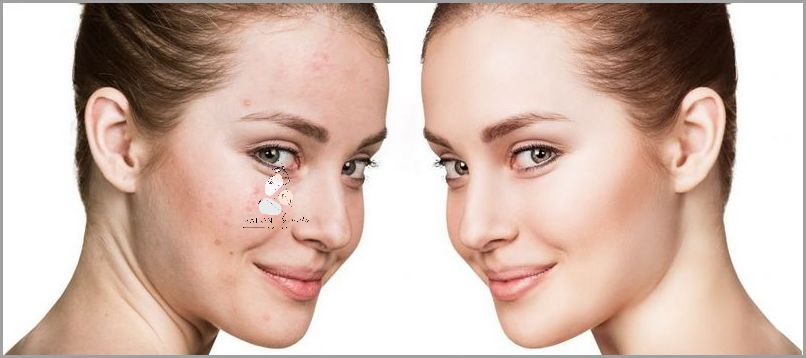 Kuracja Kwasem - Skuteczny Sposób na Trądzik Różowaty!