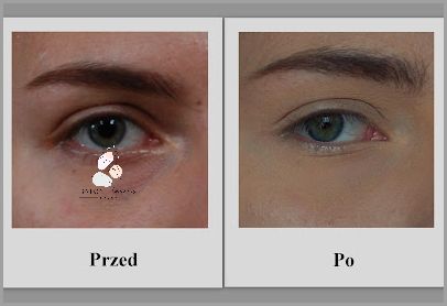 Kwas Hialuronowy Do Twarzy - To Musisz Wiedzieć!