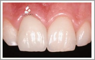 Licówki Na Krzywe Zęby - Jak Poprawić Wygląd Swojej Jamy Ustnej?