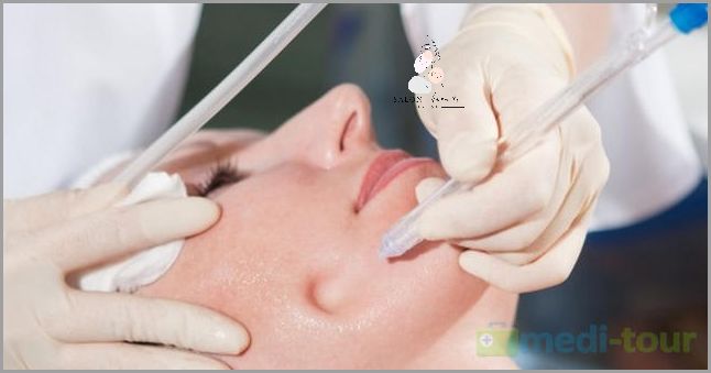 Mikrodermabrazja: Co to jest?