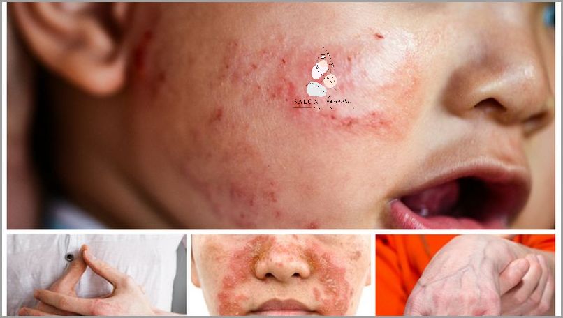 Mikrodermabrazja: Co to jest?