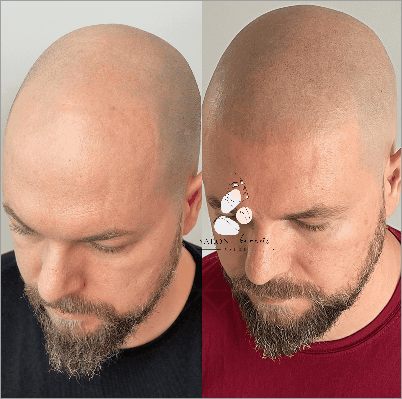 Niespodziewane Skutki Niegojących Się Strupków Na Głowie!