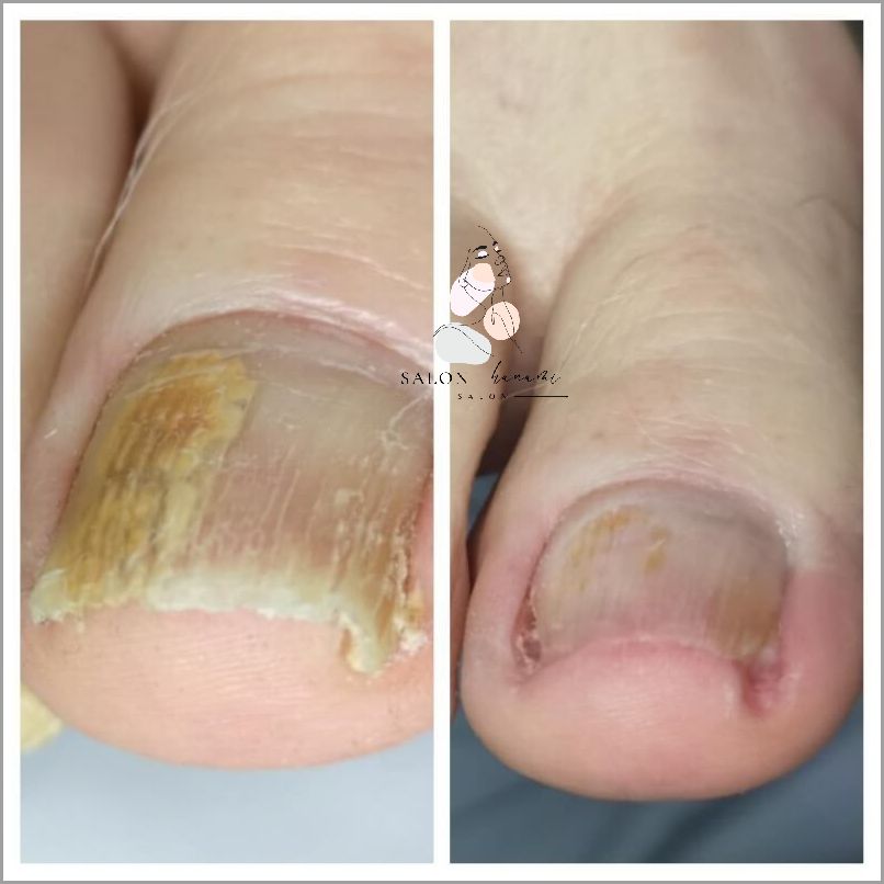 Paznokcie U Nóg Przedłużone! Sprawdź jak!