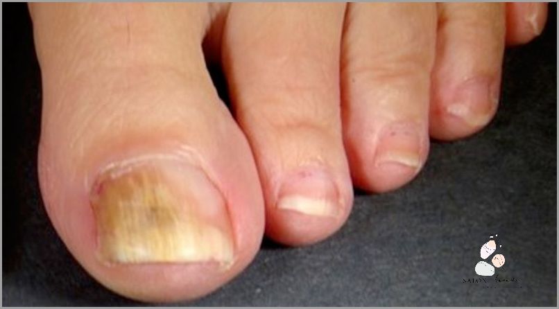 Paznokcie U Nóg Przedłużone! Sprawdź jak!