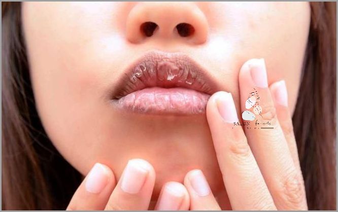 Pękające Usta Do Krwi: Co Się Dzieje?