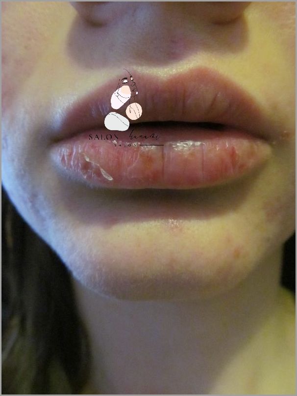 Pękające Usta Do Krwi: Co Się Dzieje?