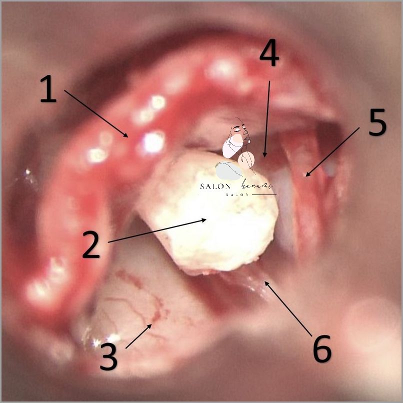 Poradnik: Stan Zapalny Dziurki W Uchu!