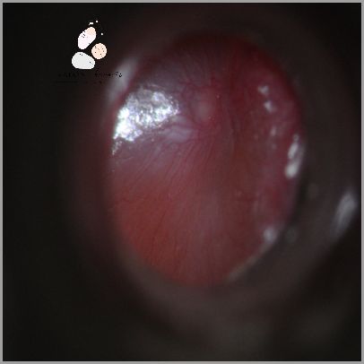 Poradnik: Stan Zapalny Dziurki W Uchu!