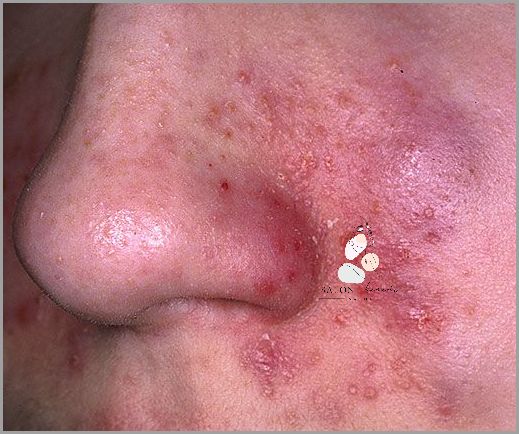 Przerażające Zdjęcia Stanu Zapalnego Skóry Twarzy! Przerażające Zdjęcia Stanu Zapalnego Skóry Twarzy!