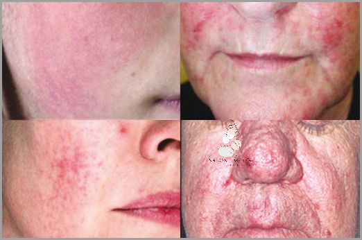 Przerażające Zdjęcia Stanu Zapalnego Skóry Twarzy! Przerażające Zdjęcia Stanu Zapalnego Skóry Twarzy!