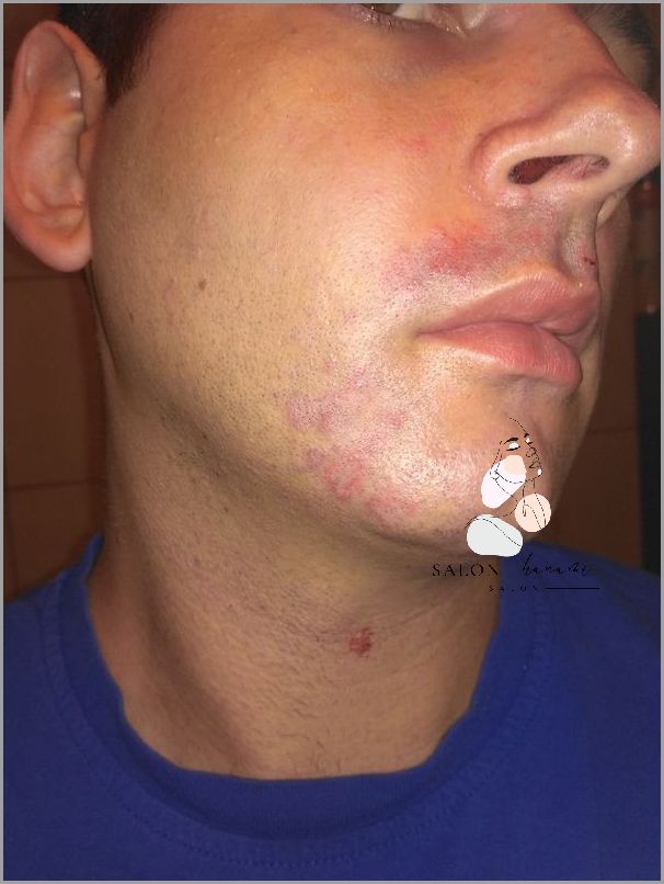 Przerażające Zdjęcia Stanu Zapalnego Skóry Twarzy! Przerażające Zdjęcia Stanu Zapalnego Skóry Twarzy!