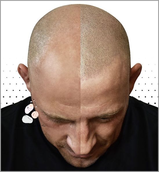 Radical Peeling Do Skóry Głowy - Natychmiastowe Rezultaty! Radical Peeling Do Skóry Głowy - Natychmiastowe Rezultaty!