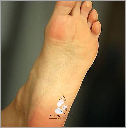 Stłuczenie Małego Palca W Stopie - Przerażające Skutki!