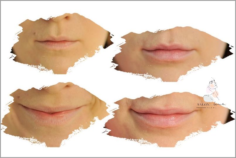 Szokujące Efekty Powiekszania Ust Dzien Po Dniu!