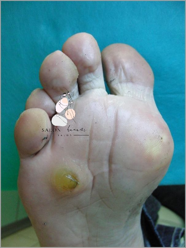 Szokujące Widoki: Odciski Na Stopie U Dziecka!