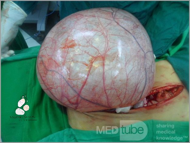 Torbiel Na Jajniku: Ciąża Niespodziewana! Torbiel Na Jajniku: Ciąża Niespodziewana!