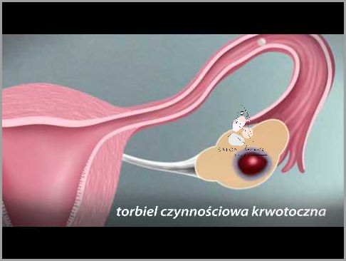 Torbiel Na Jajniku: Ciąża Niespodziewana! Torbiel Na Jajniku: Ciąża Niespodziewana!
