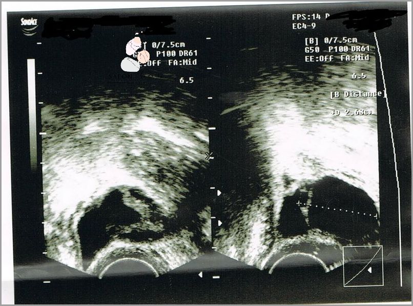 Torbiel Na Jajniku: Ciąża Niespodziewana! Torbiel Na Jajniku: Ciąża Niespodziewana!