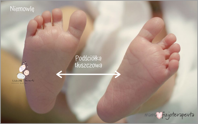 U Dziecka Wykryto Wronie Oko Na Stopie!