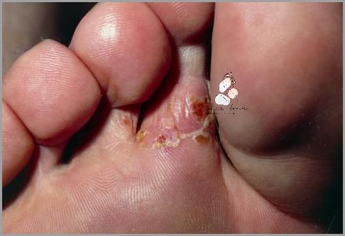 U Dziecka Wykryto Wronie Oko Na Stopie!