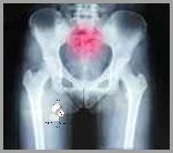 Uczucie Bólu Kości Ogonowej Bez Urazu!