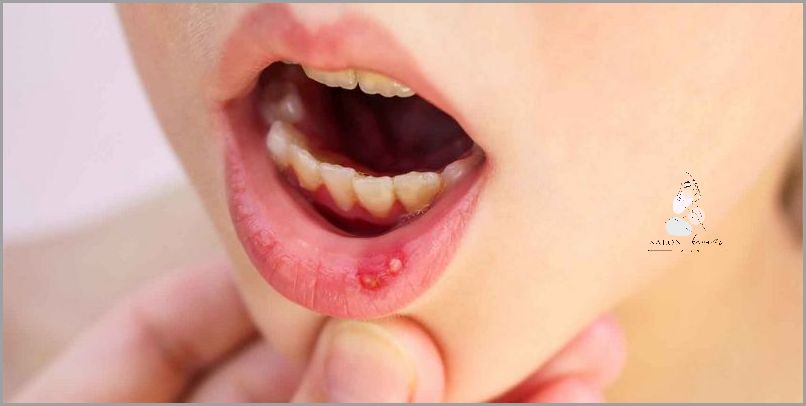 Ujawniamy Przyczyny Opryszczki Na Ustach!