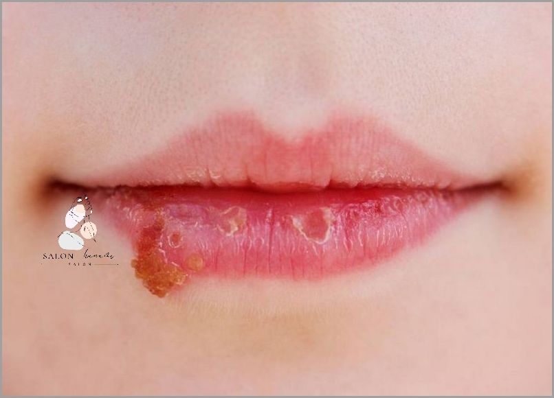 Ujawniamy Przyczyny Opryszczki Na Ustach!