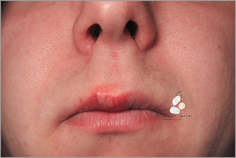 Ujawniamy Przyczyny Opryszczki Na Ustach!