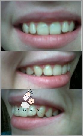 Usuwanie Przebarwień Po Aparacie Ortodontycznym!