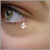 Uwaga! Poznaj Przyczyny Białych Kropki Na Twarzy!