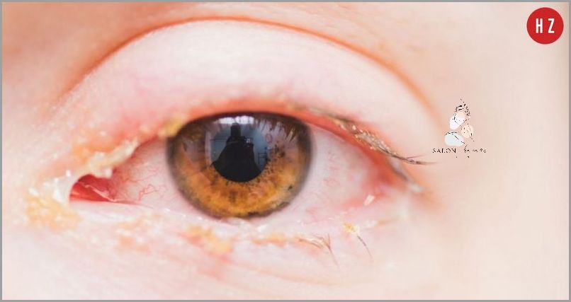 Uwaga! Poznaj Przyczyny Białych Kropki Na Twarzy!