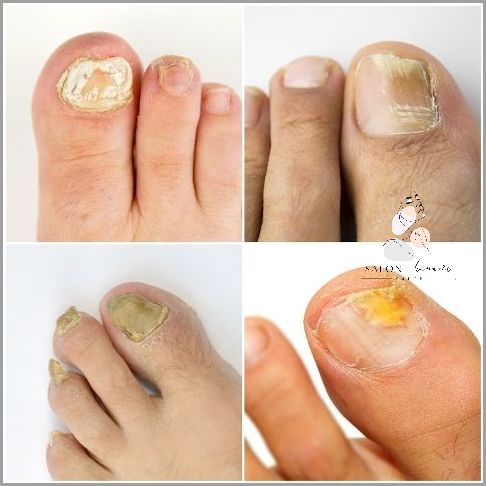 Uwaga! Sprawdź Przebarwienia Na Paznokciach U Nóg!