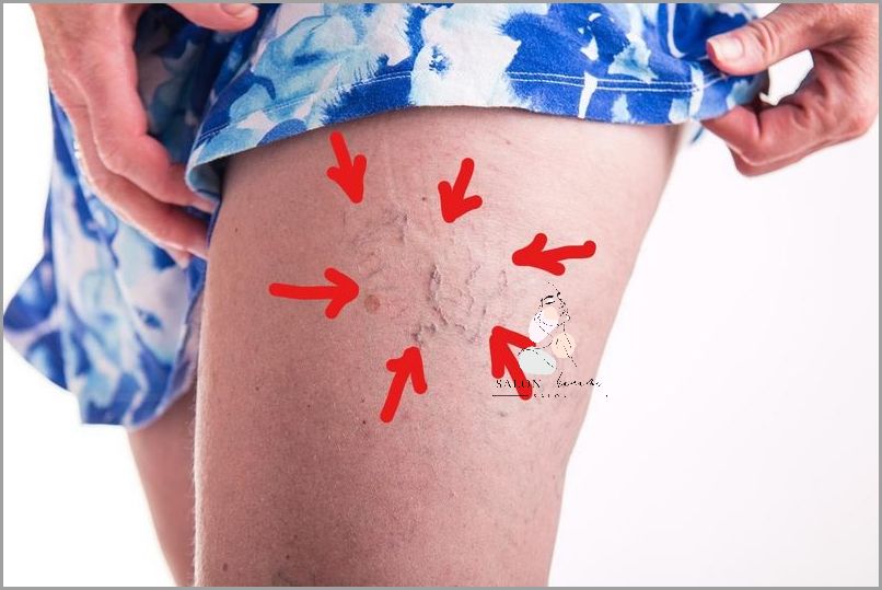 Widoczne Żyły Na Rękach - Co Oznaczają?