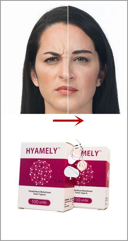 Zabiegi na Zmarszczki na Czole - Tu Dowiesz Się Więcej!