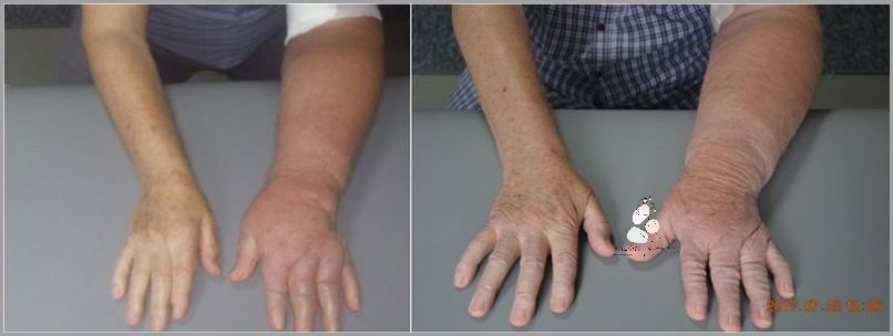 Zaskakujące Efekty Drenażu Limfatycznego!