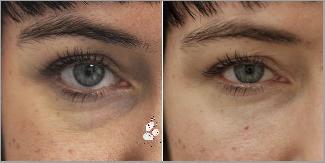 Zaskakujące Efekty Stosowania Olejku Z Kwasem Hialuronowym!