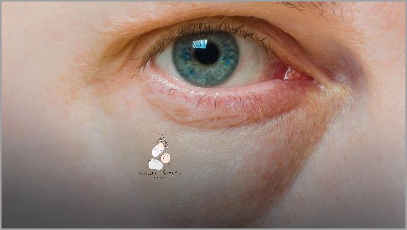 Zaskakujące Przyczyny Obrzęków Wokół Oczu!