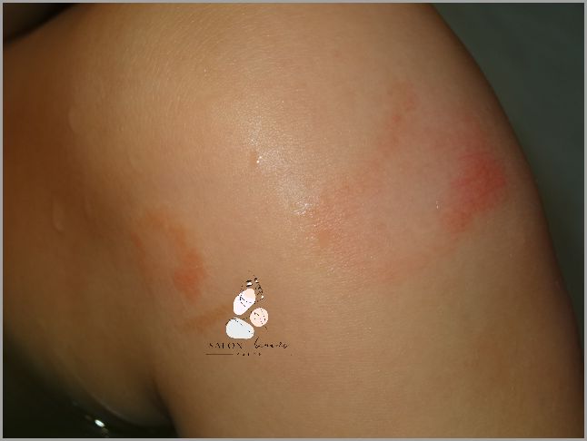 Zdjęcia: Co Oznaczają Zmiany Skórne Na Łokciach?