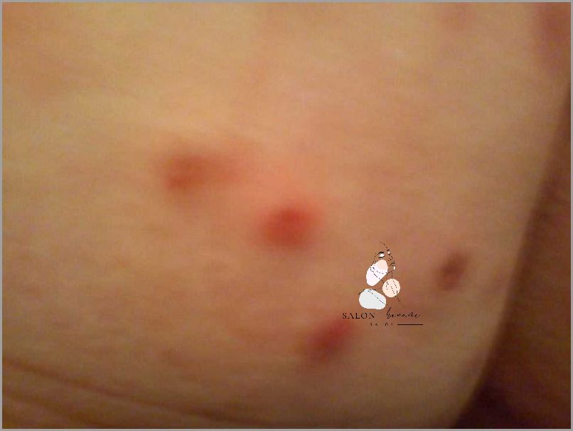 Zdjęcia: Co Oznaczają Zmiany Skórne Na Łokciach?