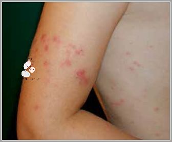 Zdjęcia: Co Oznaczają Zmiany Skórne Na Łokciach?