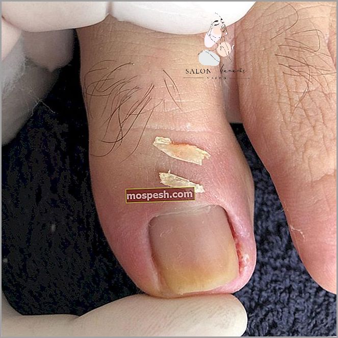 Łamiące Się Paznokcie: Czego Brakuje?