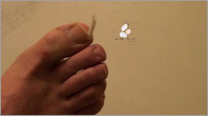 Czy Ból Dużego Palca W Stopie Przy Paznokciu Może Być Niebezpieczny?